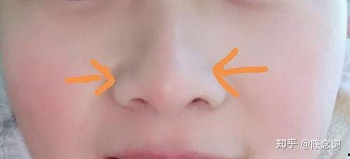 缩鼻翼视频全过程,揭秘美丽蜕变过程