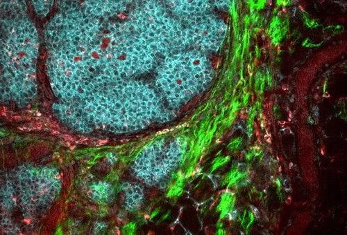 癌细胞视频,视频揭示肿瘤生长与扩散的惊人真相